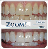 whitreteeth